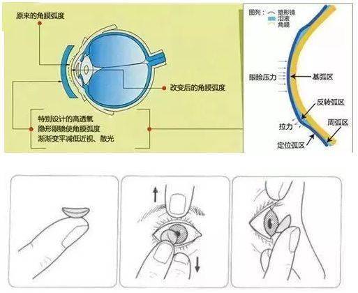 不接触角膜，佩戴更方便，离焦眼镜比OK镜强在哪儿？