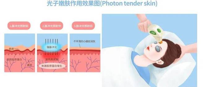 光子嫩肤是否会让皮肤变薄？医生揭晓！