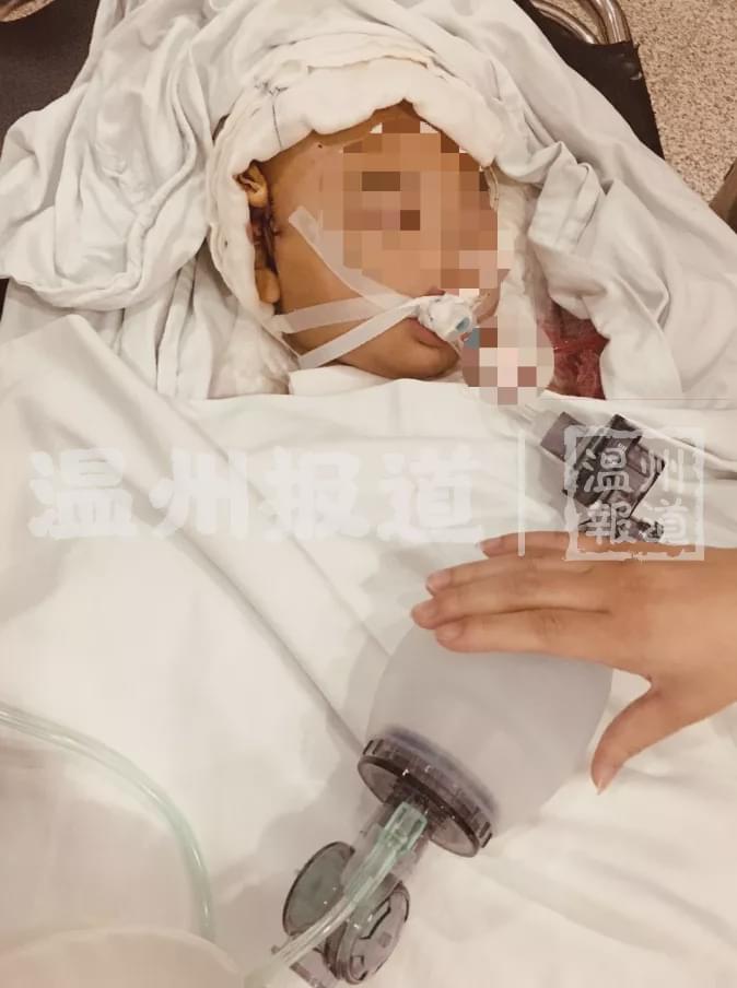 女子因佩戴鲨鱼夹意外摔倒导致重伤 陷入植物人状态的悲惨故事揭示危险性