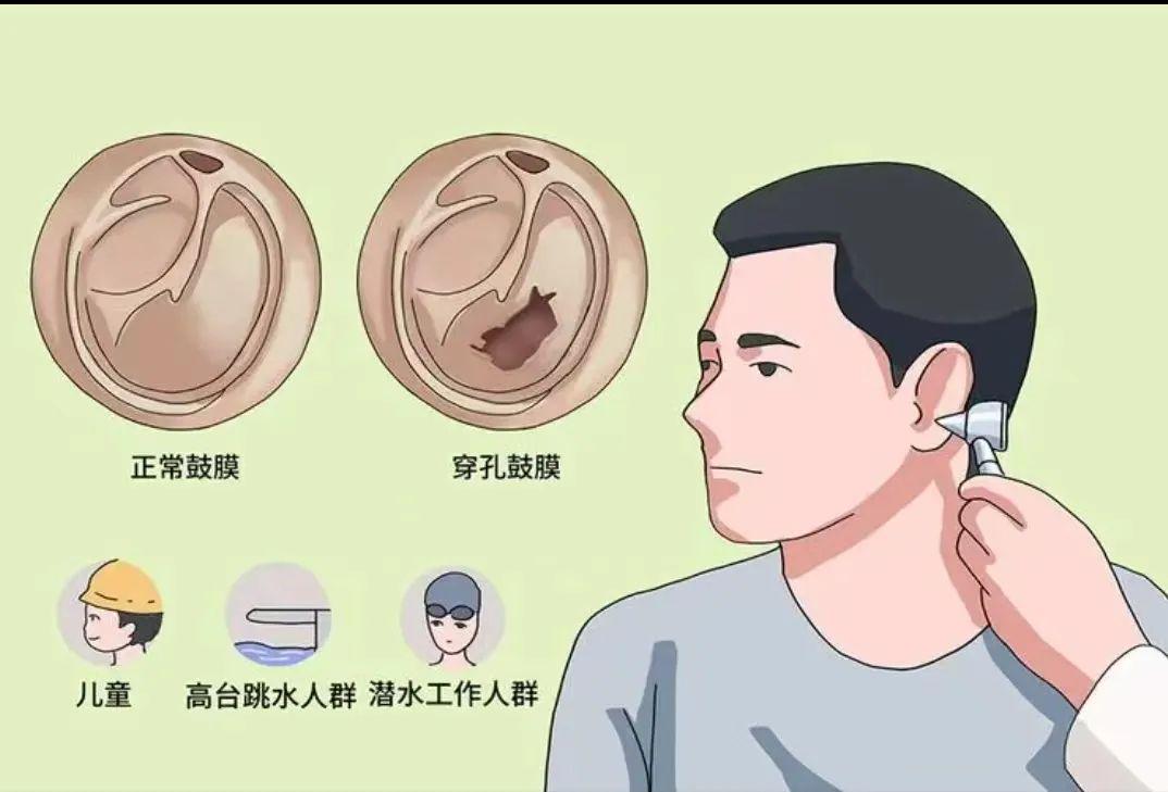 女孩在清理耳朵时意外遭男友碰撞 导致耳膜破裂的悲剧经历分享