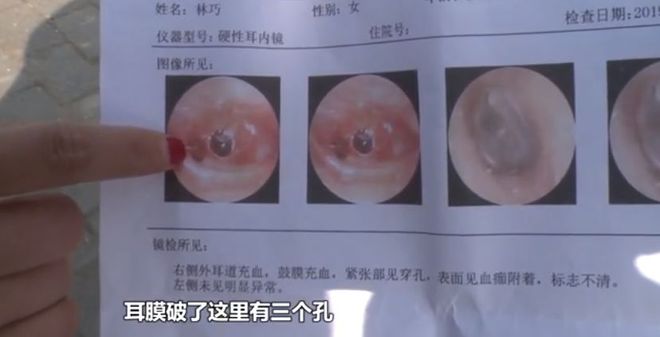 女孩在清理耳朵时意外遭男友碰撞 导致耳膜破裂的悲剧经历分享