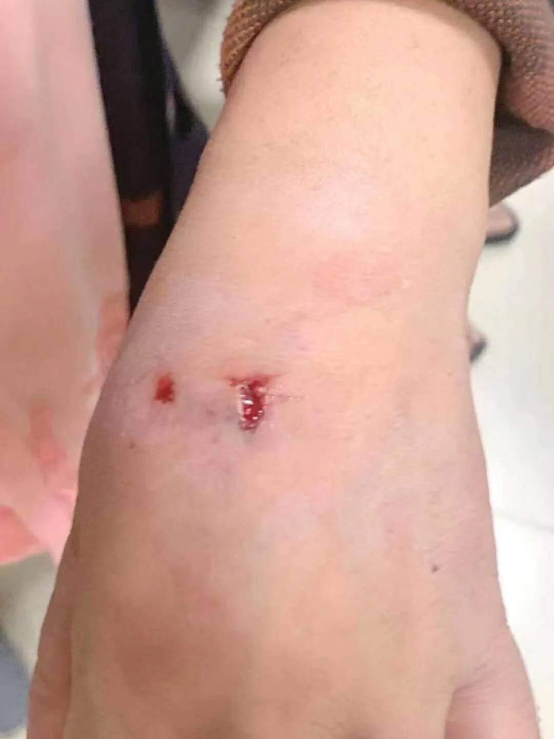 奋勇护儿童 辩护小朋友的辅警不幸遭遇狗咬伤的感人故事