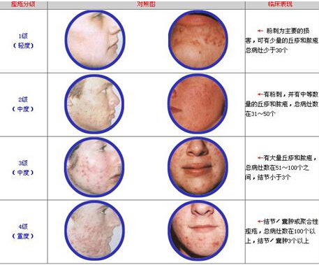 磨削痤疮疤痕效果不好