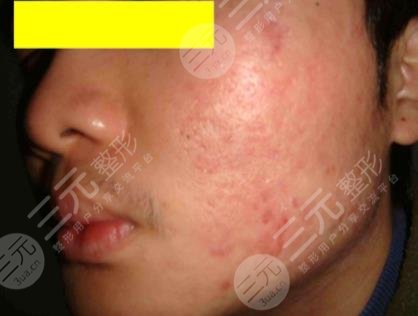 磨削痤疮疤痕效果不好